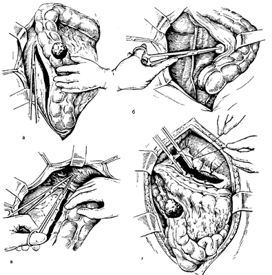 Инородное тело брюшной полости после операции