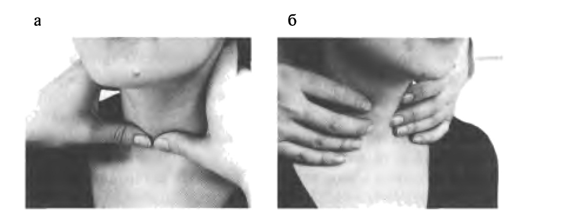 Исследование зоба. Пальпация щитовидной железы пропедевтика. Техника пальпации щитовидной железы. Техника пальпации щитовидной железы алгоритм. Пальпация щитовидной железы алгоритм пропедевтика.