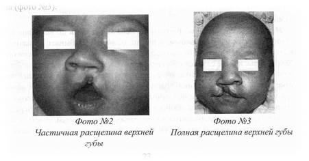 Фото до и после расщелина губы