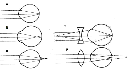 Динамическая рефракция. Статическая рефракция глаза. Схема рефракции нормального глаза. Аномалии рефракции глаза. Рефракция света схема.