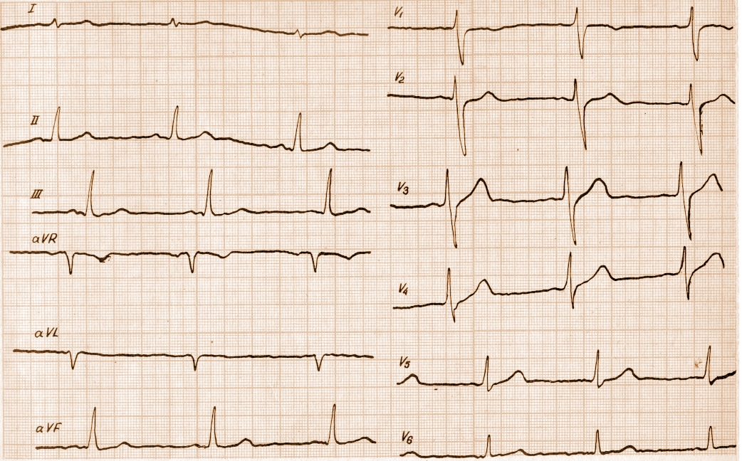 Экг 6. ЭКГ при вертикальной ЭОС. Синусовый ритм вертикальная ЭОС. ЭОС вертикальная на ЭКГ что это. Вертикальная ЭОС сердца на ЭКГ.
