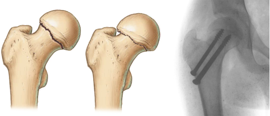 Спицы при переломе тазобедренной кости