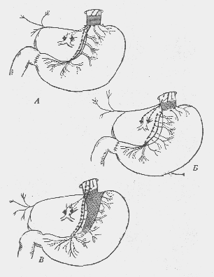 Схема операций изолированного желудка по гейденгайну и по павлову