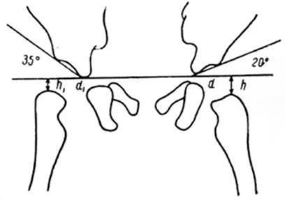 Норма углов. Ацетабулярный угол норма. Схема Хильгенрейнера. Угол Хильгенрейнера. Схема Хильгенрейнера тазобедренных суставов.