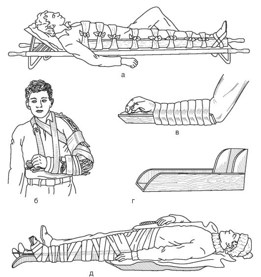 Стандартные средства иммобилизации. Транспортная иммобилизация Крамера. Иммобилизация конечности транспортной шиной. Иммобилизация нижней конечности шиной Крамера. Транспортная иммобилизация при переломах.
