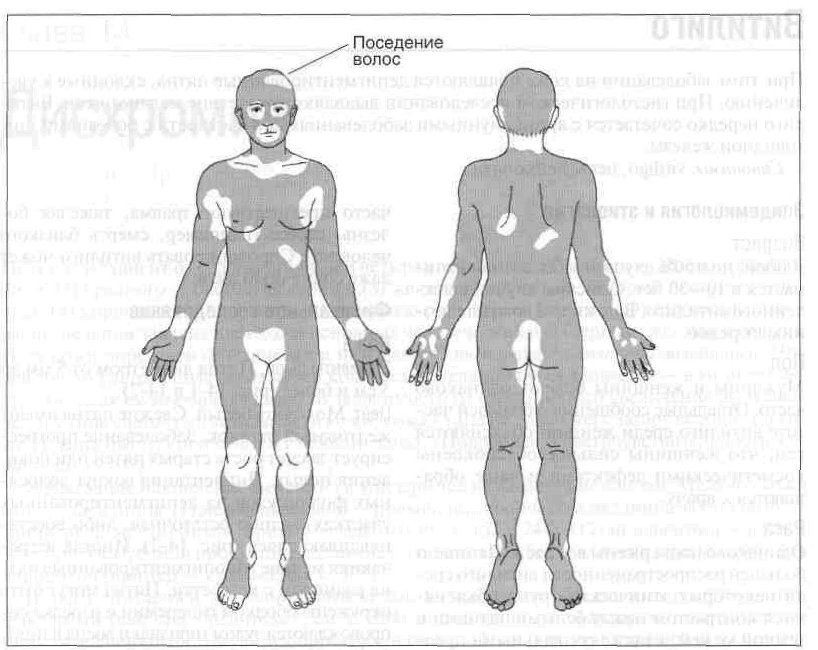 на члене витилиго фото фото 69