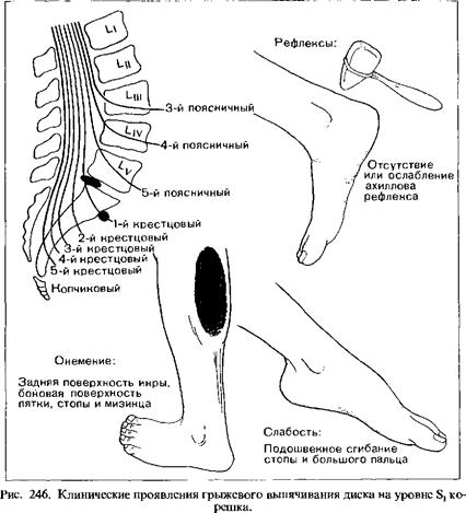 Радикулопатия пояснично крестцового. Повреждение корешка s1 симптомы. Радикулопатия Корешков л5 с1. Корешковый синдром л4 л5. Корешковый синдром s1.