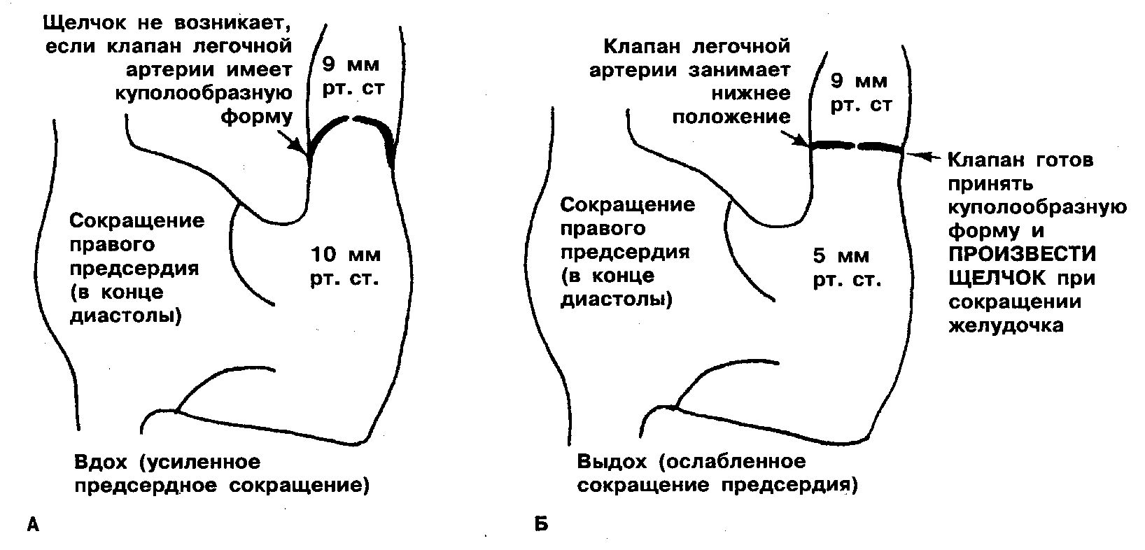 Градиент легочной артерии. Стеноз легочной артерии ЭХОКГ. Стеноз клапана легочной артерии ЭХОКГ. Этиология изолированного стеноза легочной артерии. Клинические проявления изолированного стеноза легочной артерии.