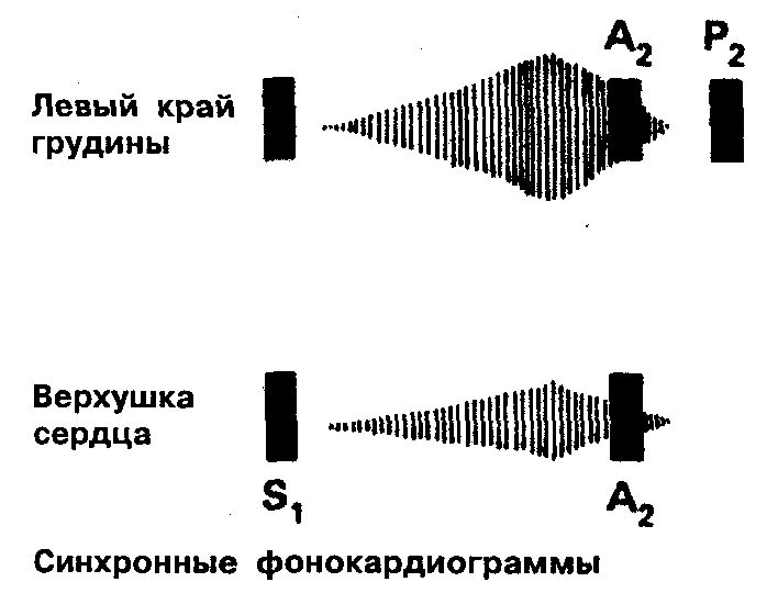 Систолический шум у левого края