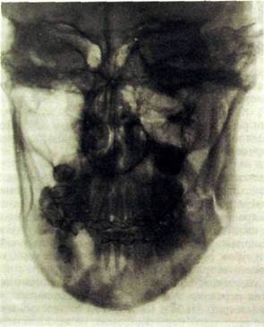Рентген перелома верхней челюсти