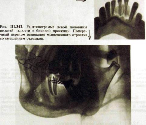 Перелом нижней челюсти описание снимка