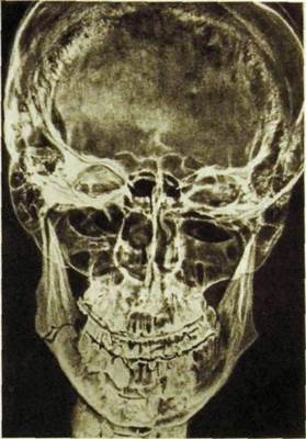 Перелом нижней челюсти рентгенограмма