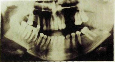 Перелом челюсти на рентгене