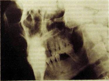 Перелом челюсти на рентгене