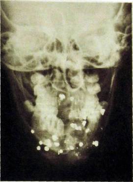 Рентген перелома верхней челюсти