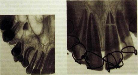 Описания рентгенограмм переломов нижней челюсти thumbnail