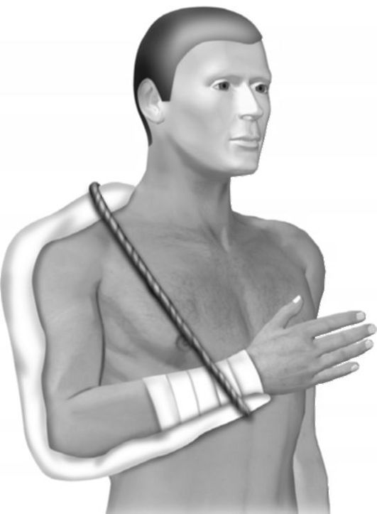 При переломе плечевой кости производят иммобилизацию суставов