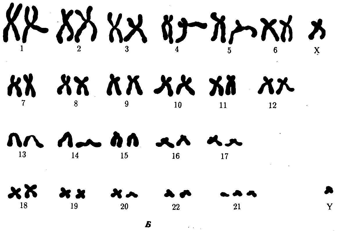 Кариотип синдрома дауна картинки