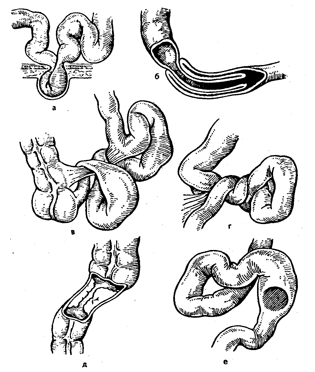 Кишечная непроходимость клинические. Заворот кишок (инвагинация). Острая кишечная непроходимость инвагинация. Обтурационная спаечная кишечная непроходимость. Спаечная кишечная непроходимость хирургия.