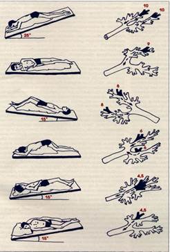 Постуральный дренаж. Методика постурального дренажа. Постуральный дренаж при пневмонии. Постуральный дренаж при бронхоэктатической болезни.
