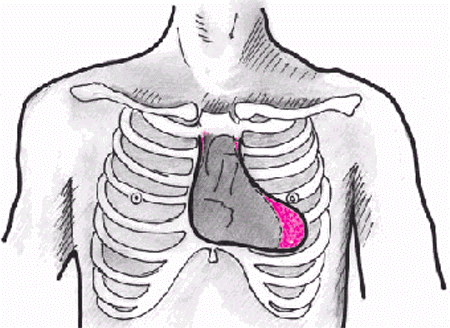 Границы расширены влево. Перкуторное расширение границ сердца. Аортальная конфигурация сердца при артериальной гипертензии. Смещение границ сердца влево. Расширение границ сердца вправо.