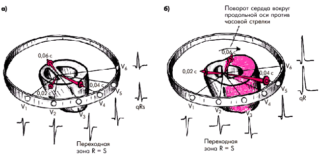 Поворот вокруг оси. Поворот сердца против часовой стрелки на ЭКГ. Повороты сердца вокруг оси на ЭКГ. ЭКГ при поворотах сердца вокруг продольной оси. Поворот сердца по часовой стрелке на ЭКГ.