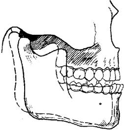 Мыщелок челюсти. Угол нижней челюсти. Мыщелки нижней челюсти. Состояние относительного покоя нижней челюсти.