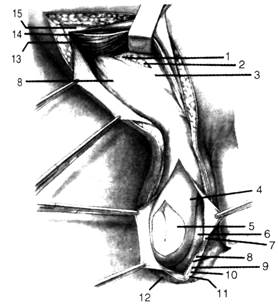 Хирургическая анатомия косых паховых грыж