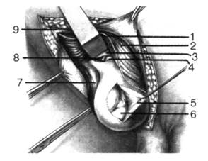 Хирургическая анатомия косых паховых грыж