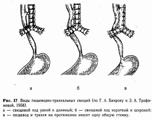 Трахеопищеводный свищ презентация