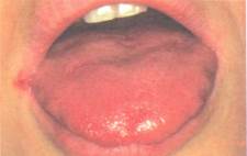 Синдром иценко кушинга в полости рта