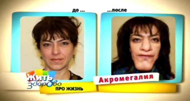 После 1 про что. Аденома гипофиза акромегалия. Женщина с акромегалией до и после. Аденома гипофиза изменение внешности.