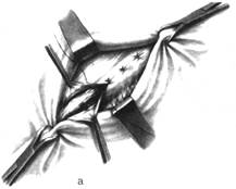 Паховые грыжи анатомия пахового канала