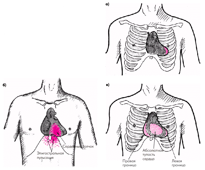 Перкуссия сердца в картинках