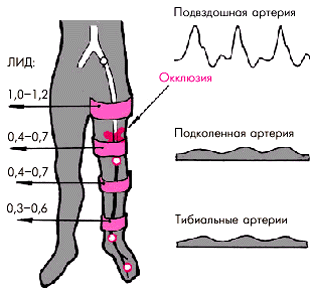 Окклюзия нижних конечностей